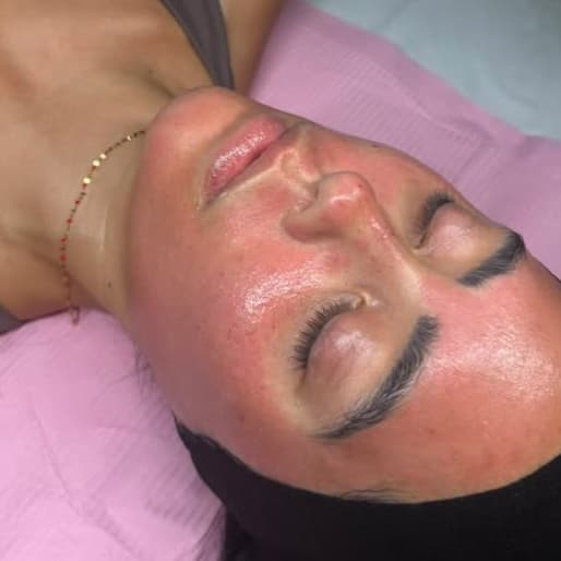 Standard Microneedle Series of 3 at HP Skin Bar in Durham, NC